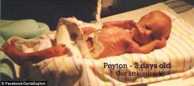 Premature: James was born more than two months early and spent the first month of his life in the hospital on pure oxygen which permanently discolored his teeth