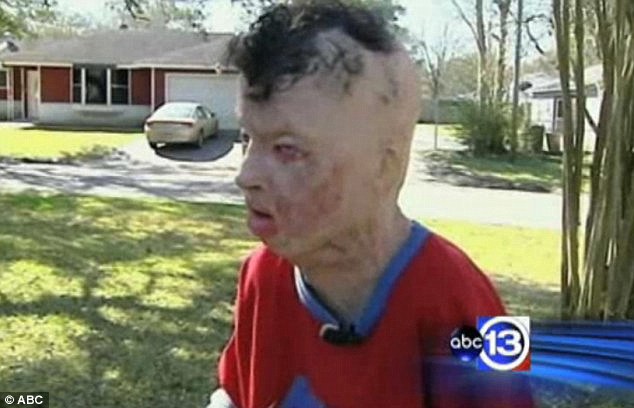 Brave face: Middleton eventually died from skin cancer in 2011, thought to have been caused by the severe burns he suffered years earlier