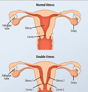 Uterus didelphys, also known as a double uterus, is a condition where a woman is born with two uterus, to separate cervixes and sometimes two vaginas, though this is not always the case
